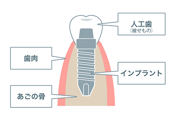 インプラント治療とは